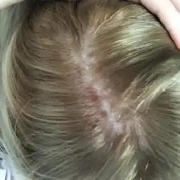 Saç İçi Yara Nedir? Belirtileri, Nedenleri ve Kozmetik Tedavi Yöntemleri
