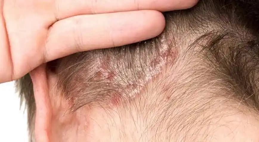 Saç Kabuklanması Nedenleri ve Çözüm Yolları: Sağlıklı Saç Derisi İçin Bilinmesi Gerekenler