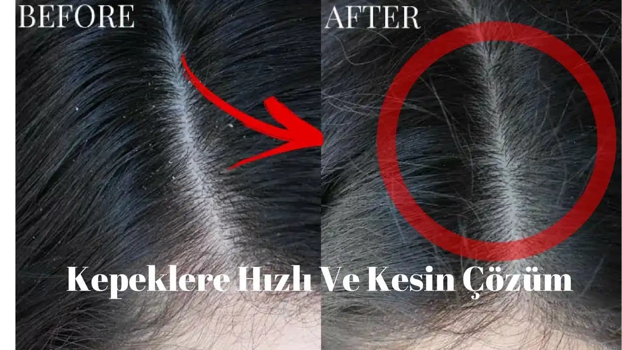 Saç Kepeğinden Kurtulmanın Etkili Yolları ve Günlük Bakım İpuçları