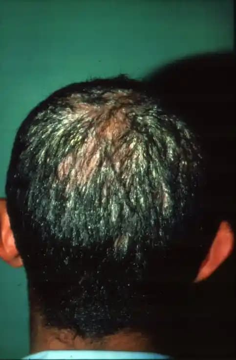 Saç Mantarına Karşı Etkili Koruma ve Bakım Yöntemleri Kozmetik Sektöründeki Yenilikler