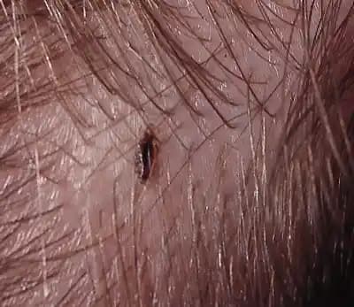 Saç Neden Bitlenir ve Bitlenmeyi Önleme Yöntemleri Hakkında Detaylı Bilgi