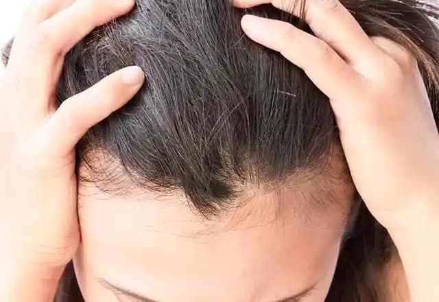 Saç Nezlesi Nedenleri Belirtileri ve Korunma Yolları Hakkında Detaylı Bilgi