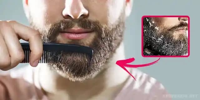 Saç ve Sakalda Kepeklenme Nedenleri, Belirtileri ve Etkili Çözüm Yöntemleri