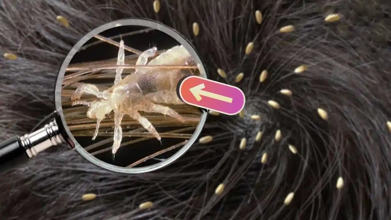 Saçta Bit Resmi Nedir, Belirtileri ve Etkili Mücadele Yöntemleri Hakkında Bilgi