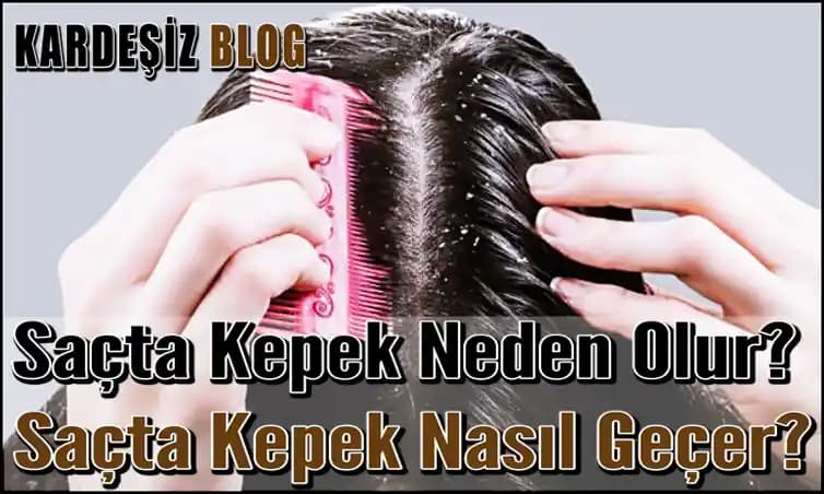 Saçta Çok Kepek Olmasının Nedenleri ve Etkili Çözüm Yöntemleri