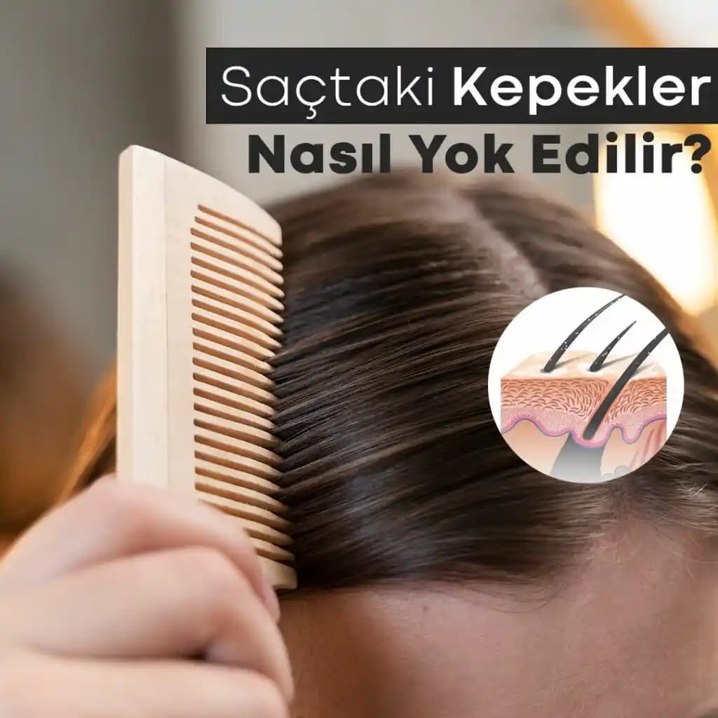 Saçtaki Sivilcelerin Nedenleri Belirtileri ve Etkili Çözüm Yöntemleri