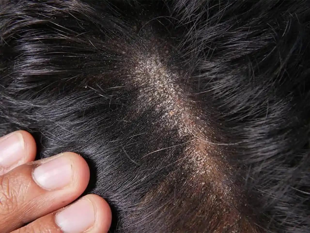 Sakal Kepeğiyle Mücadelede Doğal ve Etkili Çözüm Yöntemleri