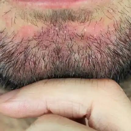 Sakaldaki Seboreik Dermatitle Başa Çıkma Yolları Güncel ve Etkili Bakım Yaklaşımları