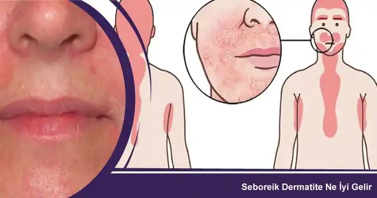 Seboreik Dermatit İçin Etkili Bakım ve Tedavi Yöntemleri Hakkında Bilgiler