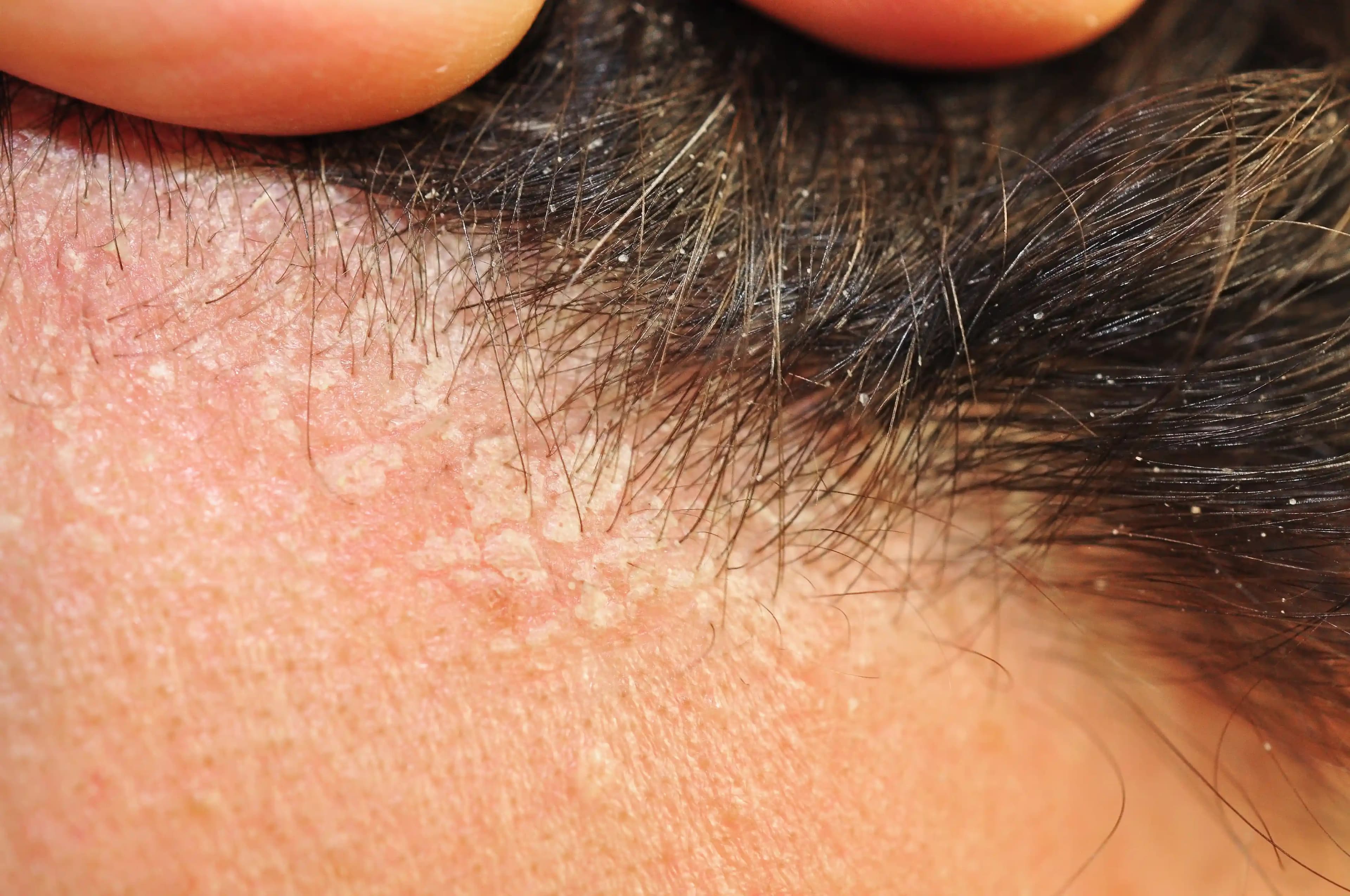 Seboreik Dermatitle Mücadelede Etkili Saç Bakımı ve Doğru Yaklaşımlar