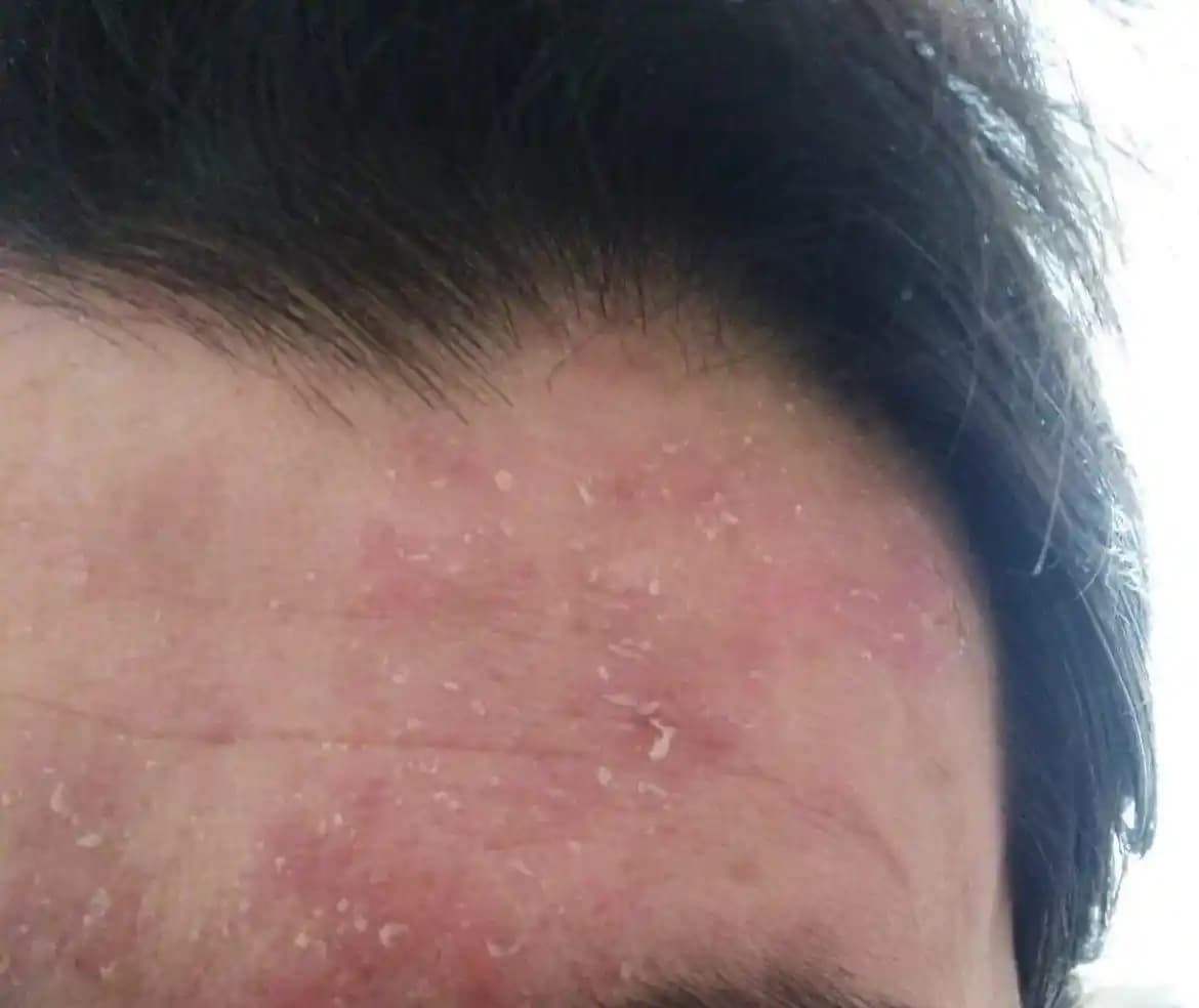 Seboreik Egzema ve Kozmetik Yaklaşımlar: Belirtiler, Nedenler ve Yönetim Yöntemleri