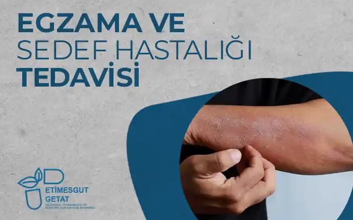 Sedef ile Egzama Arasındaki Farklar ve Cilt Sağlığını Koruma Yöntemleri