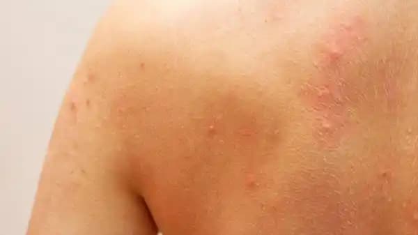 Sırt Aşırı Sivilceleri ve Etkili Kozmetik Bakım Yöntemleri Rehberi