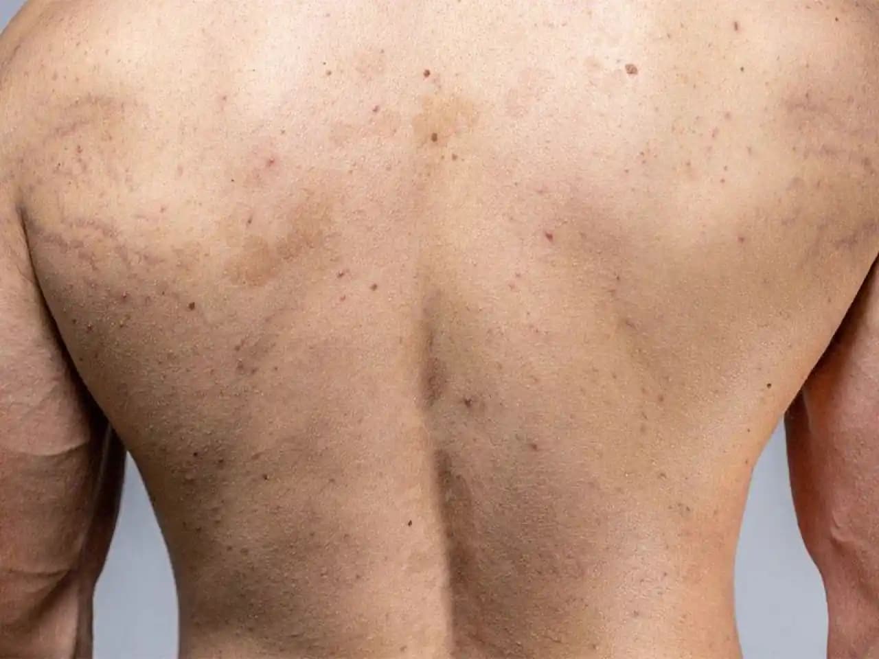 Sırtınızdaki Siyah Lekelerin Nedenleri ve Etkili Çözüm Yolları Hakkında Detaylı Bilgi