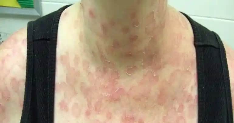 Sırtta Gül Hastalığı ve Kozmetik Bakımda Dikkat Edilmesi Gerekenler