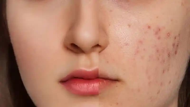 Sivilce Çıkacak Bölgeye Uygun Bakım Yöntemleri ve Cilt Sağlığını Koruma İpuçları