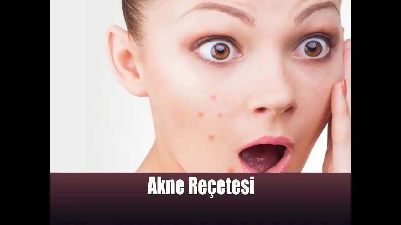 Sivilce Diyetleri ve Sağlıklı Cilt İçin Beslenme Alışkanlıkları Rehberi