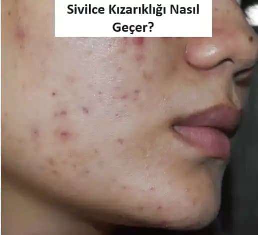 Sivilce İzi ve Kızarıklıkların Azaltılması İçin Etkili Cilt Bakım Yöntemleri