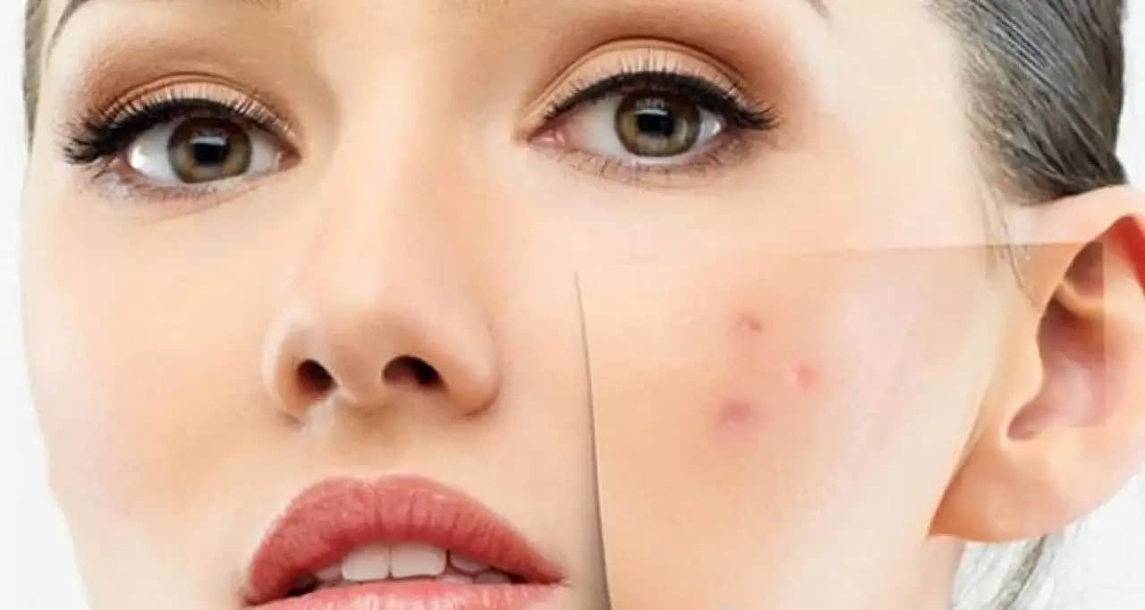 Sivilce İzleri İçin Etkili Yöntemler ve Güncel Tedavi Seçenekleri