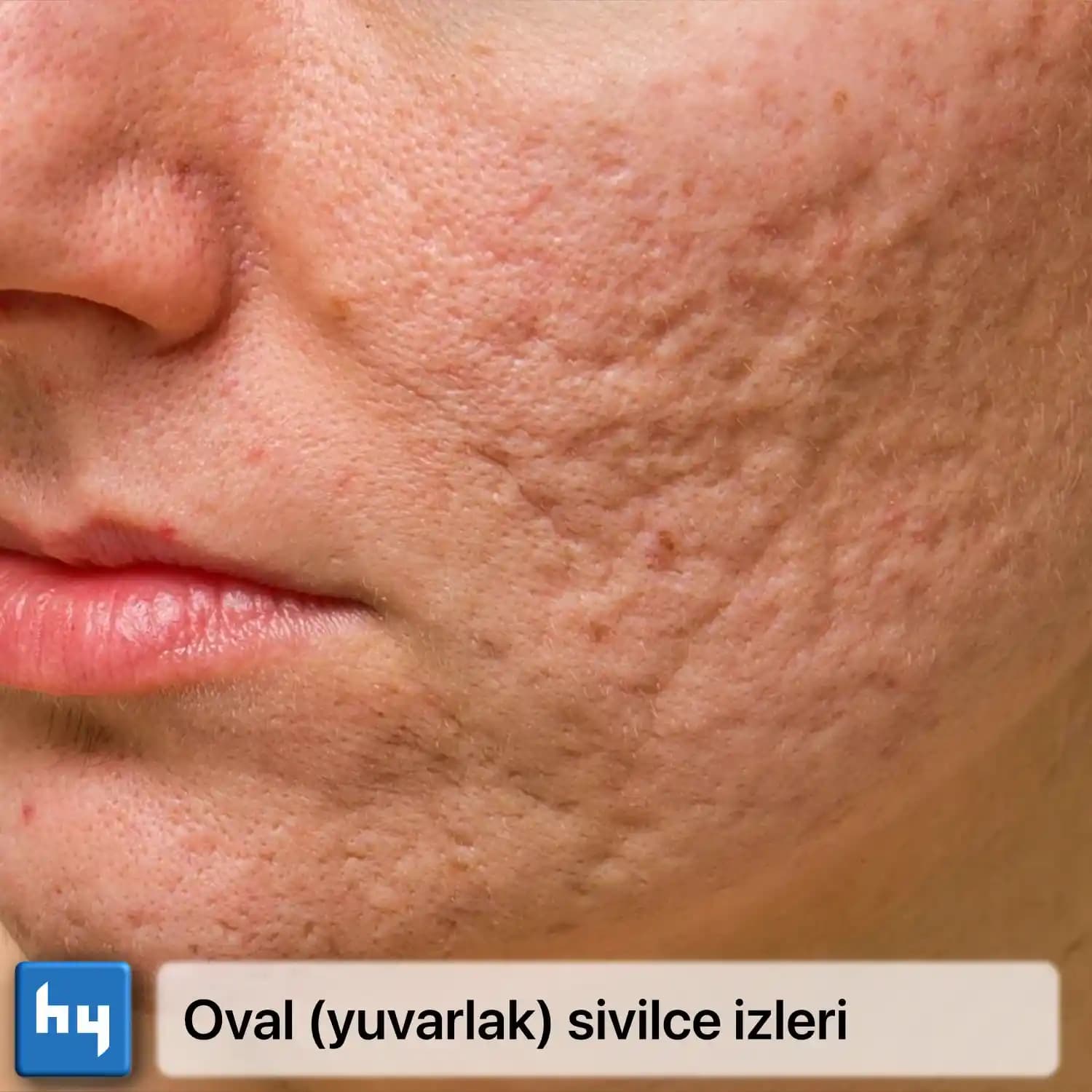 Sivilce İzleriyle Mücadele Yöntemleri ve Kozmetik Çözümler Rehberi