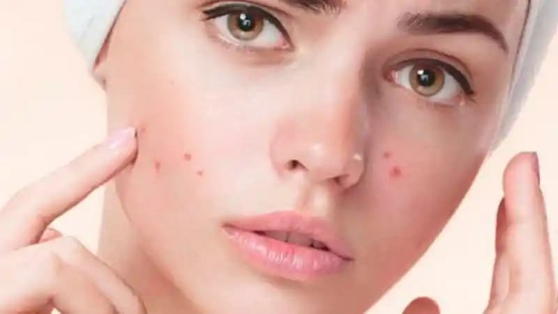 Sivilce Kaç Yaşında Geçer ve Cilt Sağlığını Koruma Yöntemleri