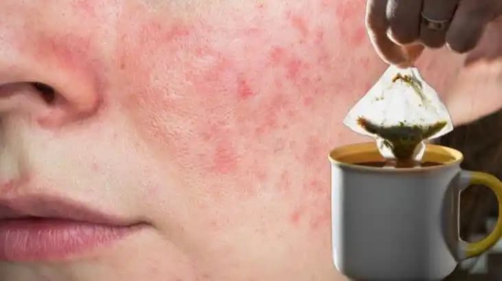 Sivilce Kızarıklığını Hafifletmek İçin Etkili ve Doğru Yöntemler Rehberi