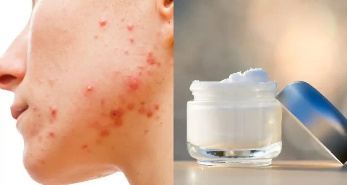 Sivilce Kremi Yanığı Nasıl Geçer En Etkili Çözüm ve Önleyici Tavsiyeler