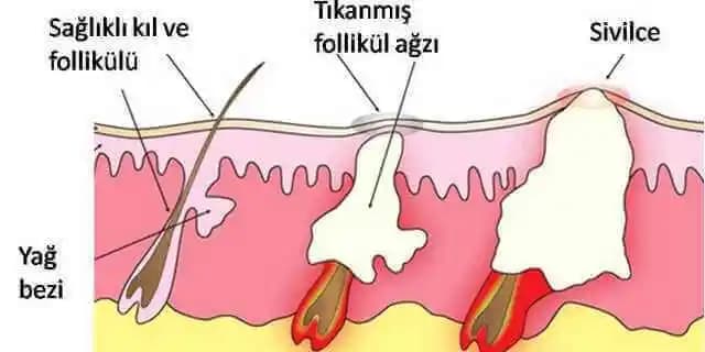 Sivilce Nasıl Oluşur ve Etkili Mücadele Yöntemleri Hakkında Detaylı Bilgi