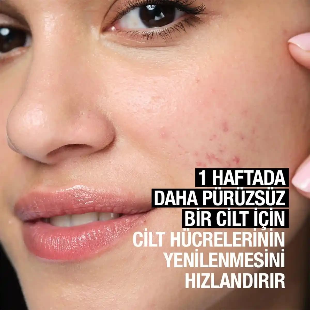 Sivilce Peelingi Nedir, Nasıl Uygulanır ve Cilt Sağlığını Destekler