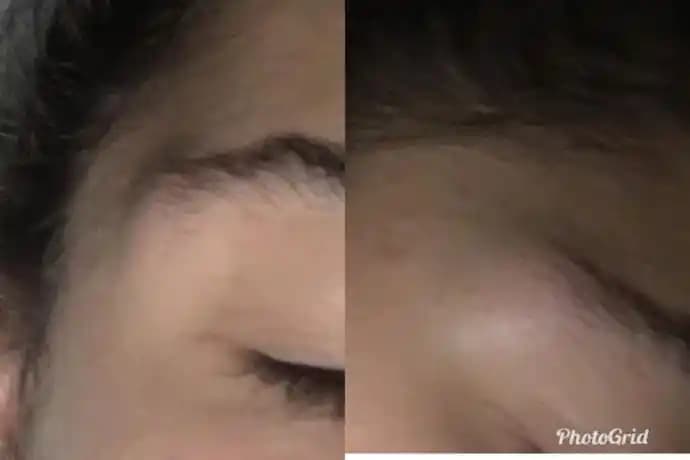 Sivilce Şişmesinin Nedenleri ve Etkili Tedavi Yöntemleri