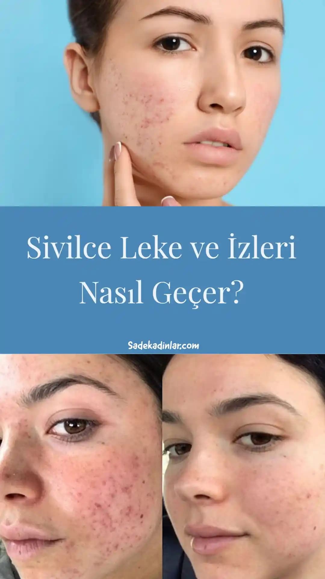 Sivilce ve Lekeler: Cilt Sağlığını Koruma ve Lekeleri Giderme Yöntemleri