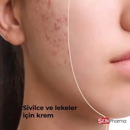 Sivilce ve Lekeler İçin En Etkili Çözüm Rehberi: Bakım ve Tedavi Yöntemleri