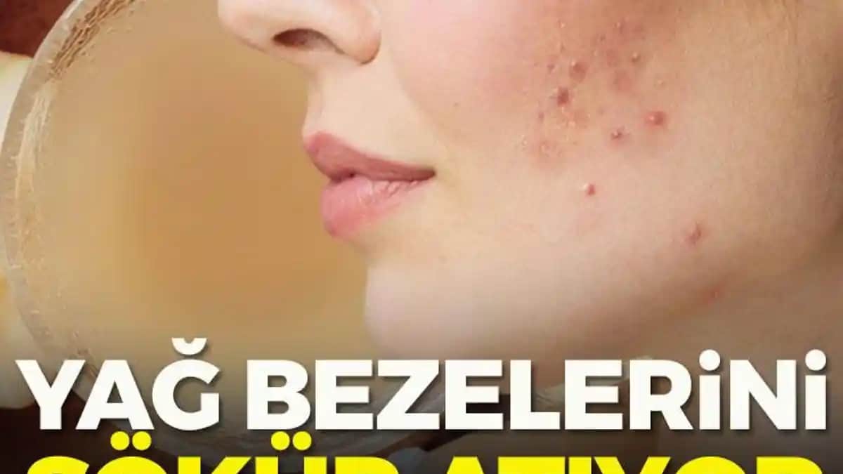 Sivilce Yağ Bezesine Karşı Kozmetik Yaklaşımlar ve Doğru Bakım Yöntemleri