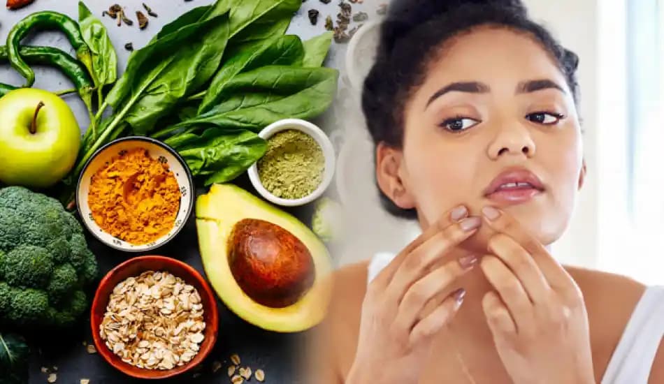 Sivilcelerle Mücadelede Doğru Beslenme ve Tetikleyen Yiyecekler Analizi