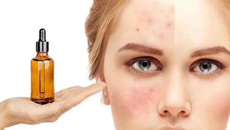 Sivilceye Karşı Doğru Yağ Seçimi ve Cilt Bakımı İpuçları