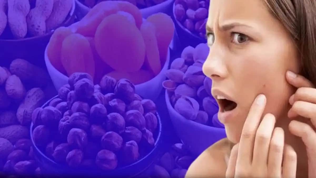 Sivilceyi Tetikleyen Yiyecekler ve Cilt Sağlığını Koruma Yöntemleri