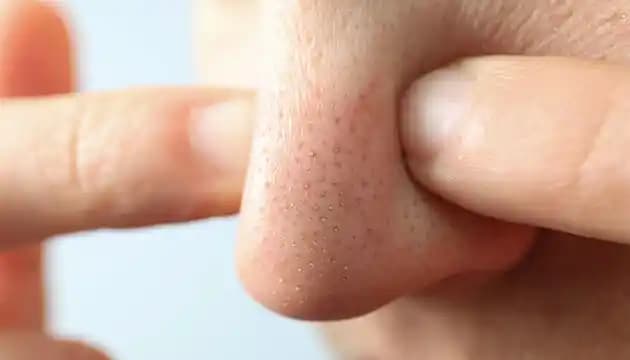 Siyah Noktalar ve Cilt Sağlığı: Nedenleri, Çözümleri ve Korunma Yöntemleri