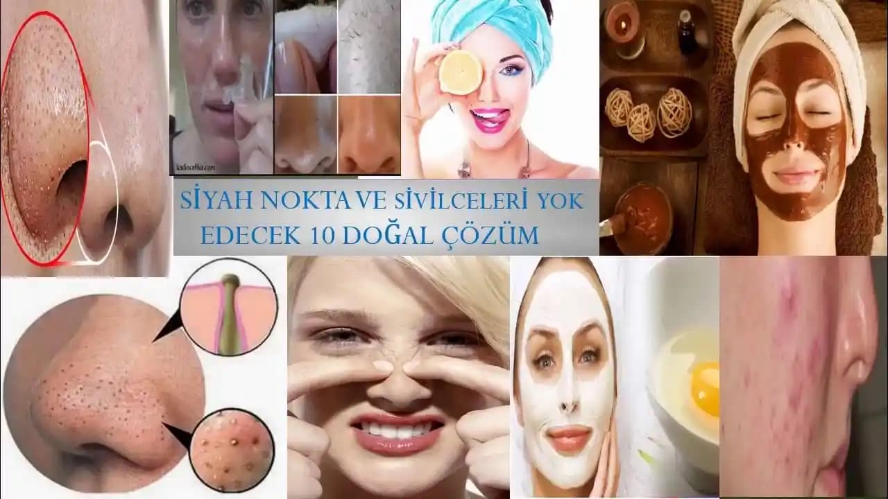 Siyah Noktalarla Başa Çıkmanın Doğal Yolları ve Cilt Sağlığını Koruma Rehberi