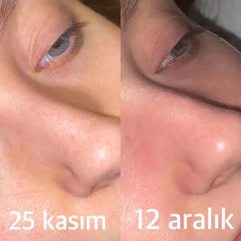 Siyah Noktalarla Mücadele ve Sağlıklı Cilt İçin En Etkili Yöntemler