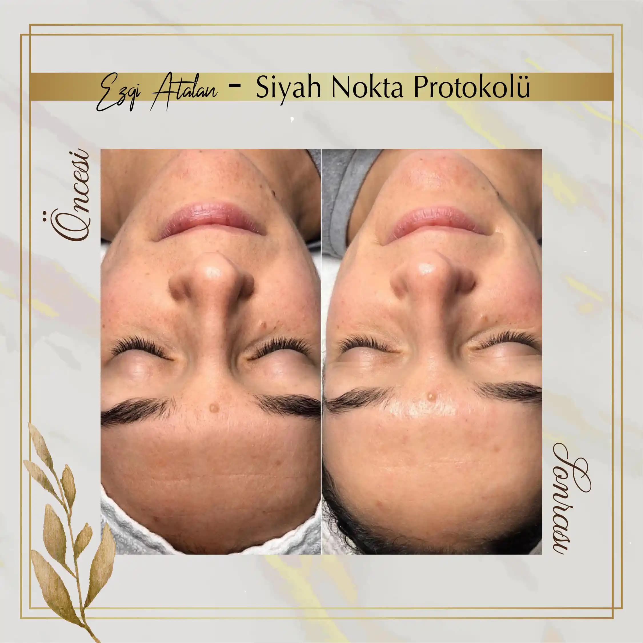 Siyah Noktalarla Mücadelede En Etkili Cilt Bakım Yöntemleri ve Tavsiyeler