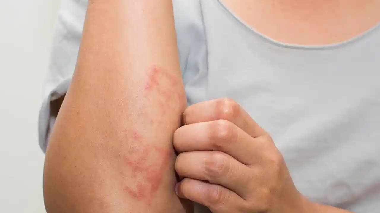 Stres ve Döküntü Arasındaki Bağlantı: Cilt Sağlığını Koruma Yöntemleri