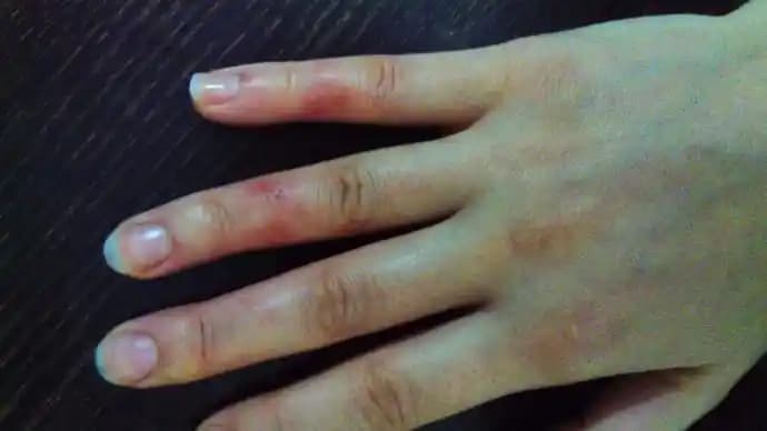 Sürtünme Kaynaklı Tahriş ve Cilt Sağlığını Koruma Yöntemleri