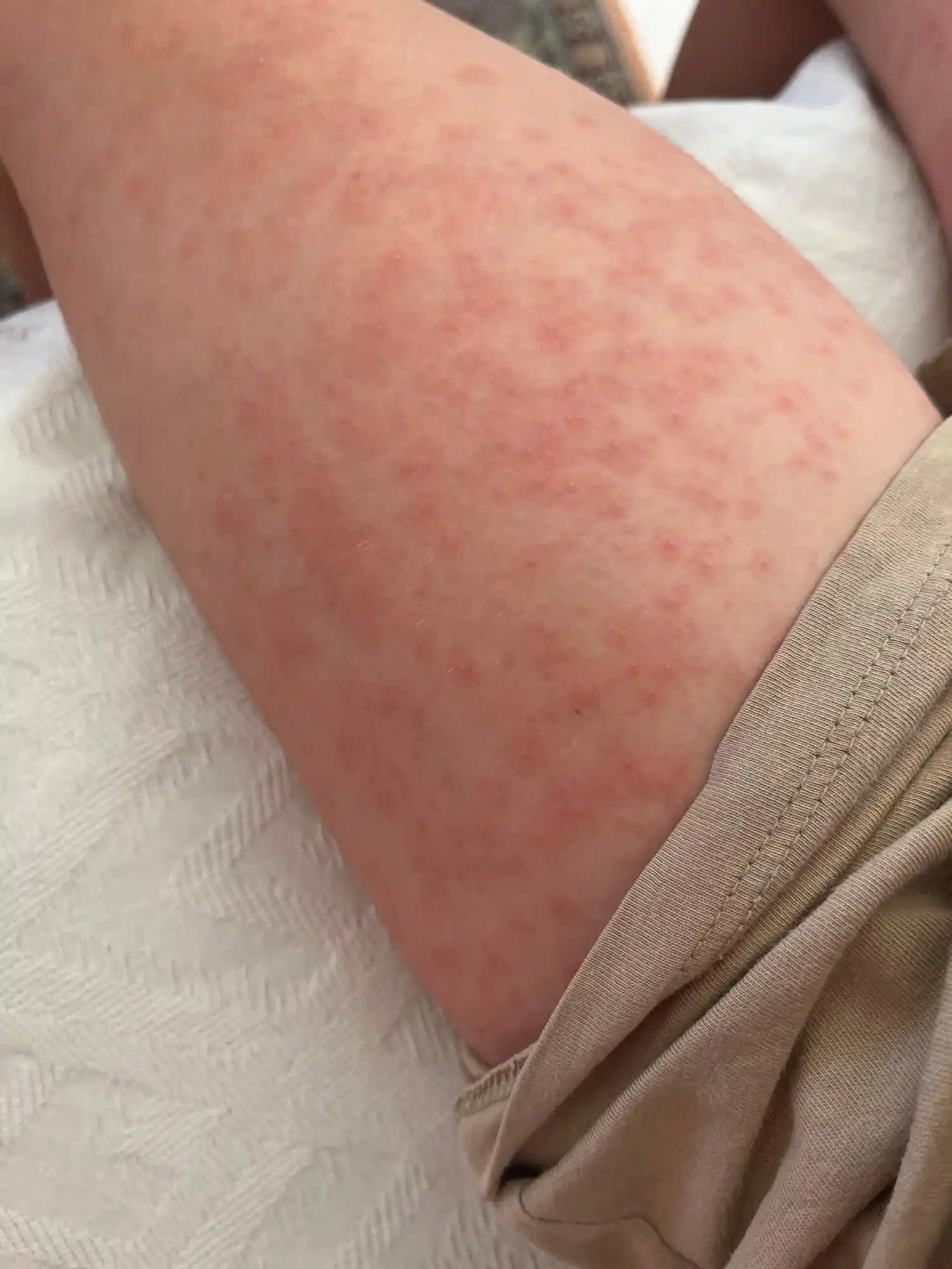 Takı Alerjisi İçin Güvenli Çözümler ve Hassas Ciltler İçin Krem Rehberi