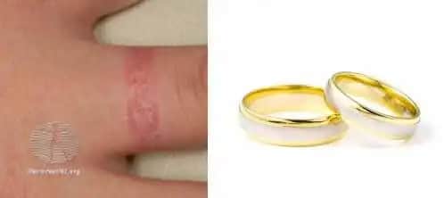 Takı Alerjisi Nedenleri Belirtileri ve Korunma Yöntemleri Hakkında Detaylı Bilgi