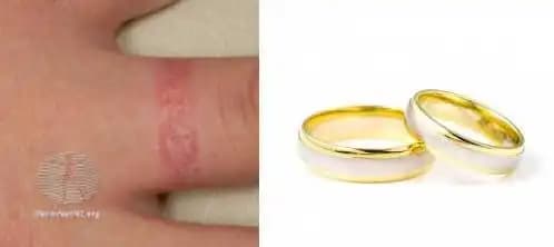 Takı Alerjisi Nedenleri Belirtileri ve Korunma Yöntemleri Hakkında Detaylı Bilgi