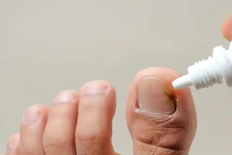 Tırnak Batması İçin En Etkili Kremler ve Doğal Tedavi Yöntemleri