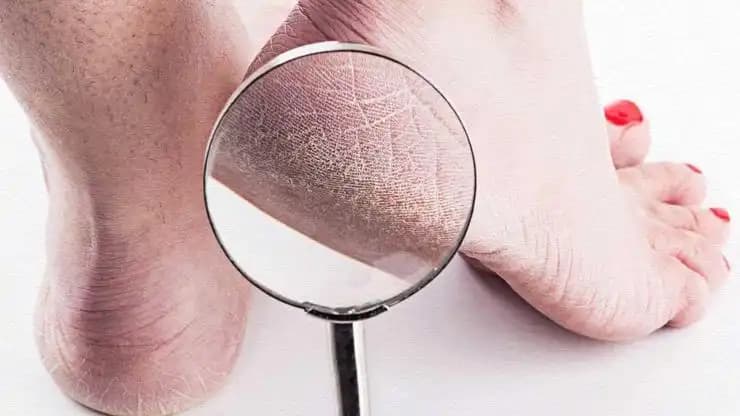 Topuk Çatlaklarının Nedenleri, Tedavi Yöntemleri ve Bakım İpuçları