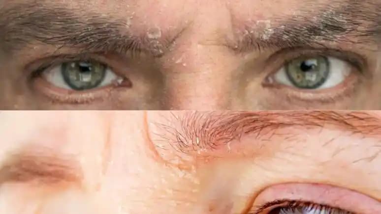 Vücut Kepeklenmesinin Nedenleri ve Kozmetik Çözüm Yolları