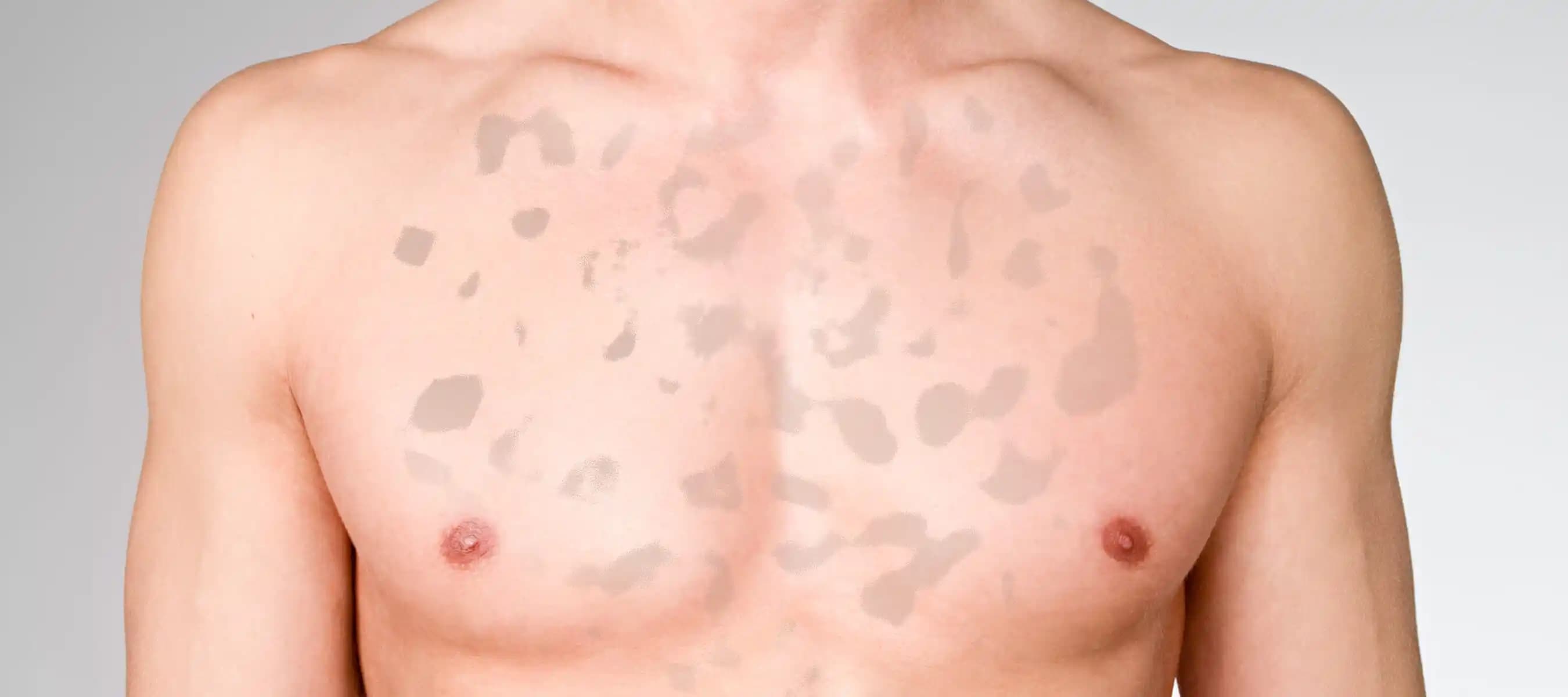 Vücut Mantarları ve Cilt Sağlığı: Belirtiler, Önlemler ve Tedavi Yöntemleri