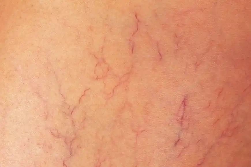 Vücutta Damar Çatlaması Nedenleri ve Güzellik ile Sağlık İçin Alınabilecek Önlemler